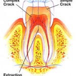 crack tooth