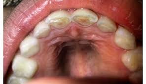 calculus buildup on bar of my tongue ring